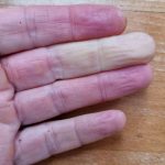 Four fingers, with middle finder showing classic Raynaud's symptom of colour loss.