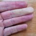 Four fingers, with middle finder showing classic Raynaud's symptom of colour loss.